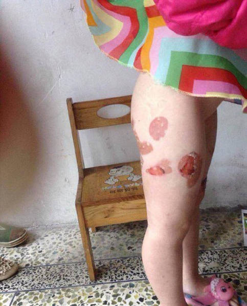 4岁女孩被父亲用汤勺灼烫虐待
