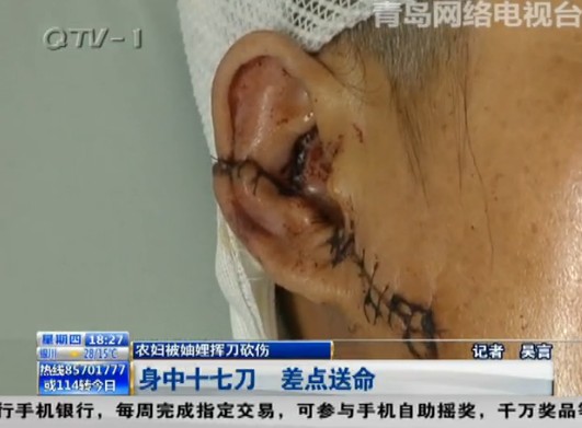 妇女被妯娌砍17刀 抱腿求饶遭砍烂肩膀(组图)