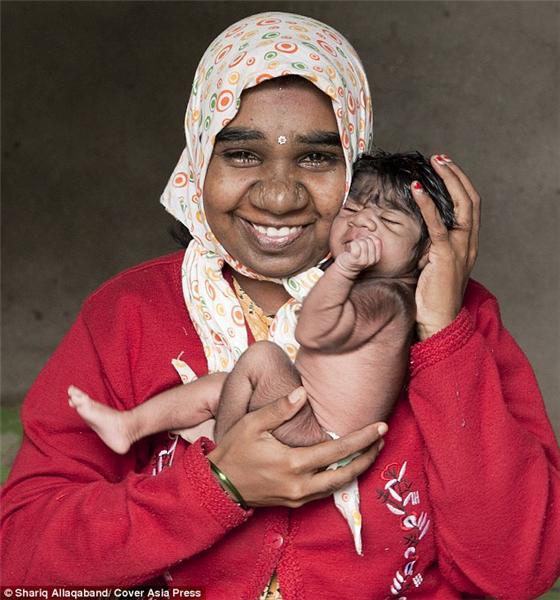 印度一名女婴遗传狼人基因 全身黑毛酷似狼孩