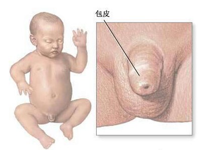 图解男宝宝“包皮”的秘密手术