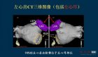 中国医院现场直击：房颤经导管射频消融术