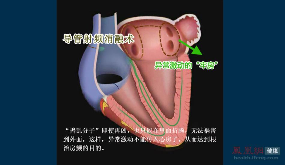 中国医院现场直击：房颤经导管射频消融术