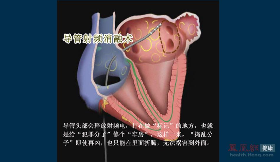 中国医院现场直击：房颤经导管射频消融术