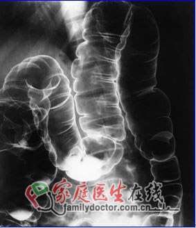 胸部X线检查能查哪些病?全面分析X线作用