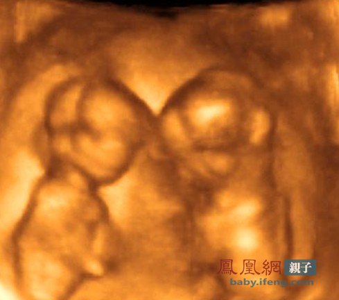 警惕:双胞胎在子宫内会掐架 抢血可致死