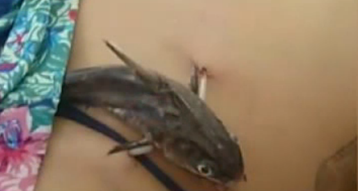 实拍女子游泳时被鲶鱼攻击 鱼鳍刺破腹部挂身上