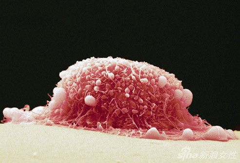 人体揭秘:图解什么是宫颈癌组(图)