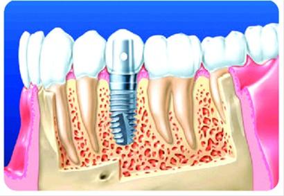种牙最好的牙齿 41a1fe5246539862e2fb079f7177de6f.jpg
