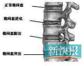 腰椎间盘突出 颈椎病 椎管狭窄