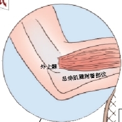 外上髁是前臂伸肌群的起点,如果前臂伸肌群被动牵拉(如握拳、屈腕)和主动收缩(如伸腕)过多,肌肉起点处就发生不同程度的撕裂。