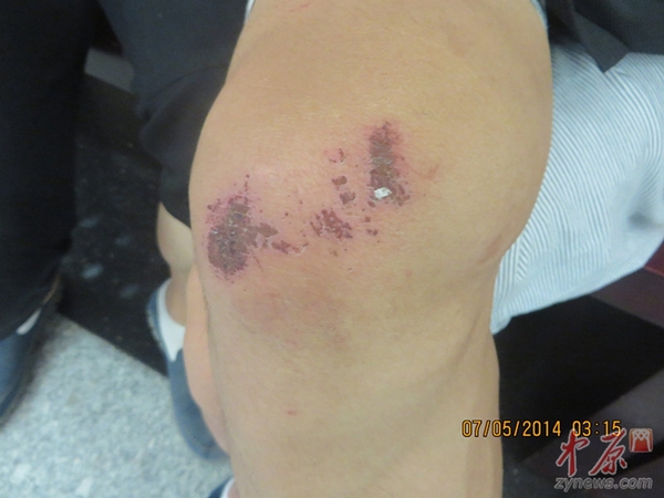 7月2日,中铺镇至会川镇途中,李征受伤了