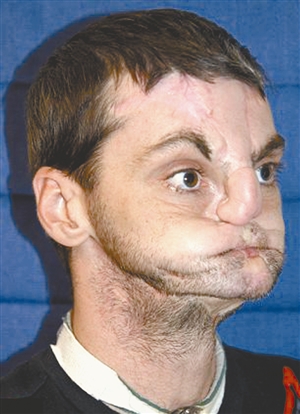 美国男子换脸后 登时尚杂志封面|医生|外科_凤凰资讯