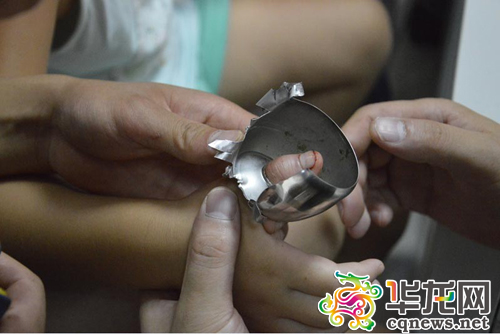 女孩由于好奇，把拇指插进了火锅店的一把没有锁芯的坏锁内，导致拇指卡在锁孔的金属套上拔不出来。丰都消防供图 华龙网发