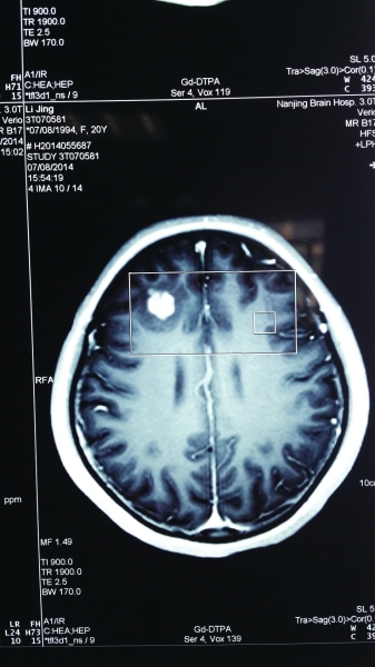ct扫描显示,小静脑中高亮处疑是寄生虫.