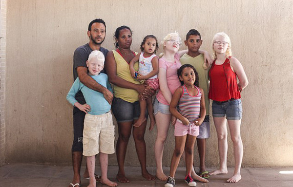 　　据悉，安德莱德与前夫都是白化病基因携带者。他们将这种基因传给了3个孩子。