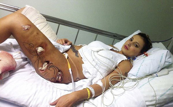 巴西模特安德瑞莎·马拉赫日前公布了其许多可怕照片，显示其接受整容手术感染对身体造成的伤害。（网页截图）