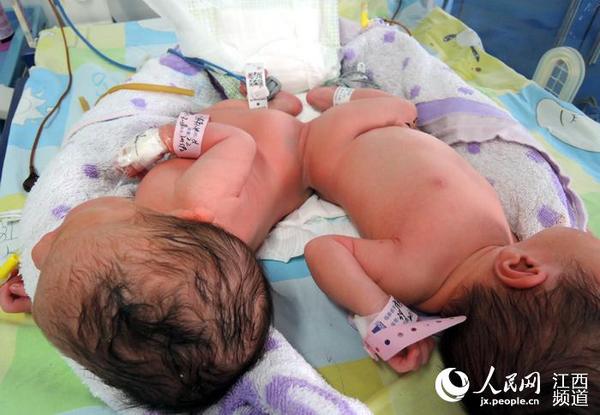 江西宁都一孕妇产下连体女婴 连夜奔赴<em>上海准</em>