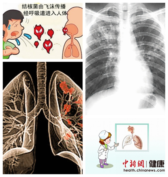 我国肺结核患者数量居世界第二位 春季呼吸道疾病易复发