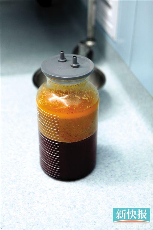 160斤胖妞超励志瘦身真人秀|脂肪|针眼