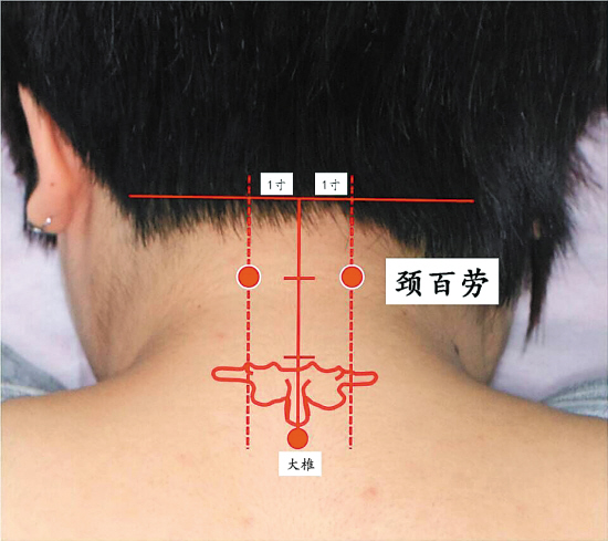 灸百劳穴助夏日护肺|棘突|大椎穴_凤凰资讯