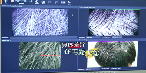 白<em>头发</em>越<em>拔</em>越多?假的|<em>头发</em>|<em>毛囊</em>_凤凰资讯