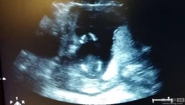 　　孩子在14周在肚子中动的样子。