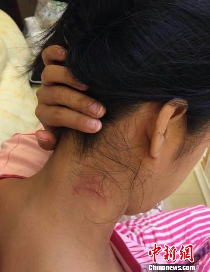 图为被殴打的李女士展示伤痕。　钟欣 摄
