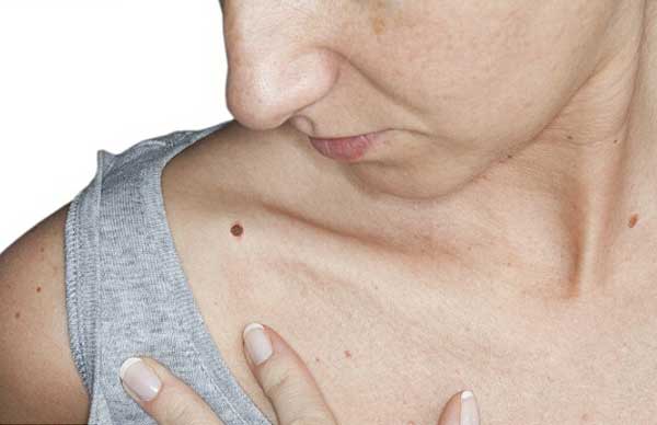 体表的黑痣是皮肤癌的早期信号。（图片来源：英国媒体）