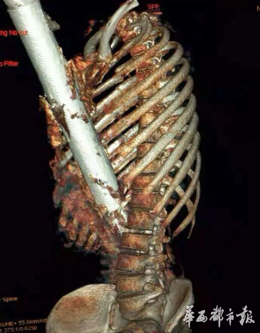 黄师傅体内的钢管有1.2米长。