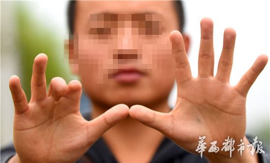 4月5日,左手二个手指有缺失的韩先生想考驾照。