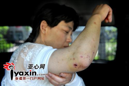 4月25日，程女士身上的伤痕仍清晰可见。 亚心网首席记者 张万德 摄