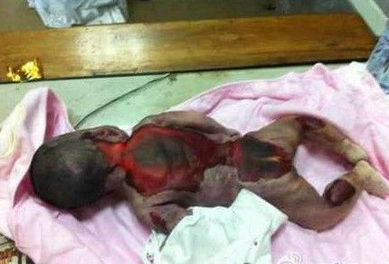 12天新生儿在医院保温箱中被烤死官方调查(图