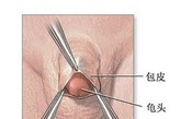 包皮环切术最常见的指征是出于文化或宗教的要求。其它的指征有：*包茎或包皮过长；阴茎头包皮炎。