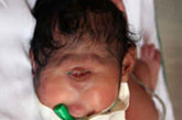 2006年,印度出生一个单只眼睛的女婴,帮助接生的医疗人员认为这个畸形