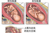 　插取胎血有两种通路：1.直入胎盘，2.穿过羊膜囊。取血点一般位于脐带与胎盘相连的地方。

　　如果胎盘位于前位，穿刺将直接在胎盘上取血，不必通过羊膜囊。羊膜囊是一充满液体的空腔组织，保护着胎儿。

