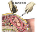 在超声探头的引导下，医生将针插入胎盘插取少量的胎血。
