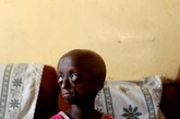 12岁的Ontlametse Phalatse是世界上迄今发现的唯一一名患有早衰症的黑人女童。