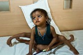 印度2岁的小女孩拉克什米·塔特玛天生竟长着4只胳膊和4条腿。虽然这在当地村民眼中是一种“神的馈赠”，但要想带着多余的手脚继续生存是不可能的。