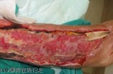 坏死性筋膜炎

这是一种很严重的病，这种病是由于食用了糟糕的食物。患有这种病的病人的皮肤好像腐烂一样。

