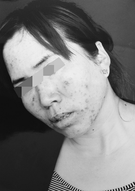 爱美<em>女士</em>遭遇毁容 契尔氏<em>脱毛膏</em>,脱毛还是脱