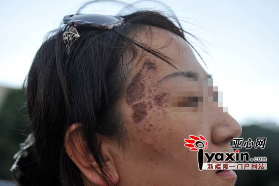 陈女士脸上的伤痕已经结疤。亚心网记者 赵宇