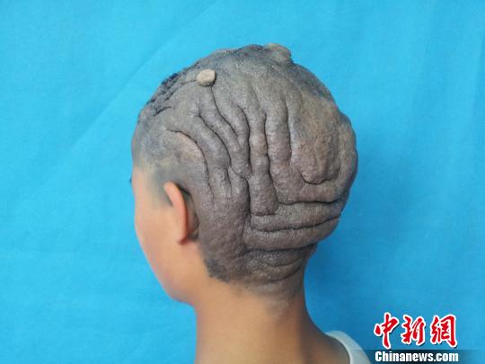 年仅13岁的吴梅患上了回状头皮。　西南医院整形科供图　摄