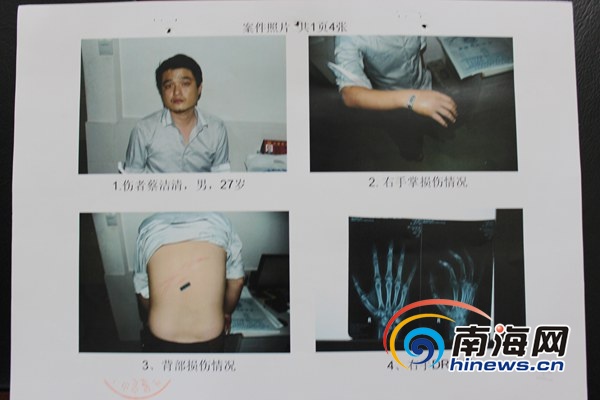 　　　经鉴定蔡某为轻伤，右手骨折(实习生毛亚晶摄)