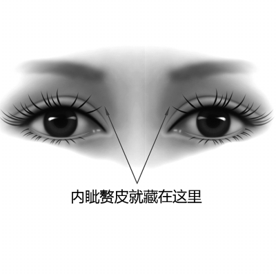 处有一块内眦赘皮