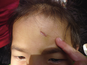 幼儿园老师甩东西误中小女孩 额头缝了六七针