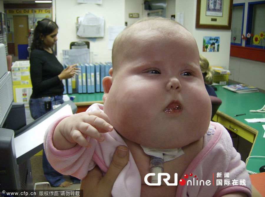 美国4岁<em>女孩</em>患先天<em>疾病</em>如同大头娃娃(高清组