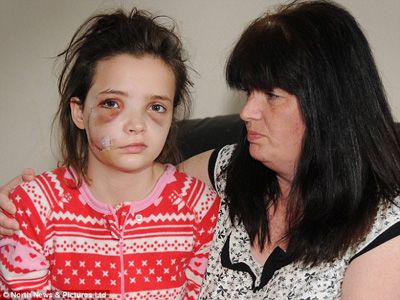 英国13岁少女被德国牧羊犬袭击近乎毁容(图)