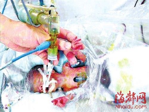 广东41岁产妇 产下600克巴掌婴儿