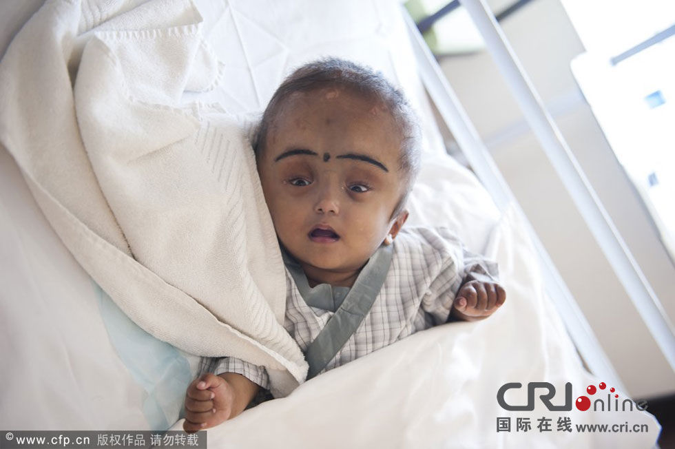 印度大头娃娃手术成功身体健康头部已缩小(