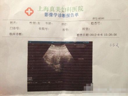 怀孕30天双胞胎b超图片图片